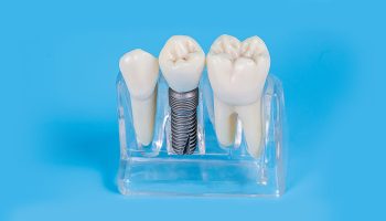 Follow-Up Care after Dental Implant Surgery