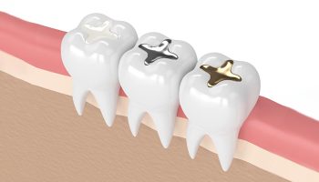 Dental Filling: Types and Expenditure