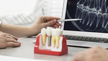 Should You Go for Same-Day Dental Implants or Not?
