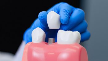 10 Long-Term Oral Health Benefits of Choosing Dental Implants
