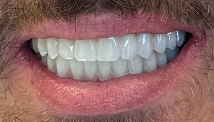 After-Porcelain Veneers