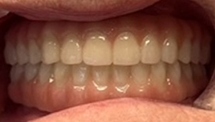 After-Before-After