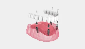 Benefits of All-on-4 Dental Implants for Full-Mouth Restoration