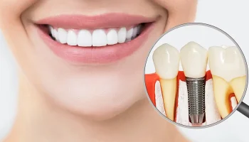 How Dental Implants Help Prevent Bone Loss in the Jaw