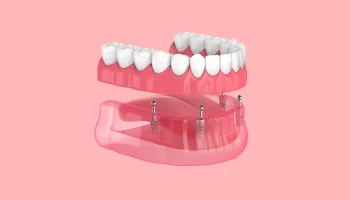 Can You Get Teeth in a Day with All-on-4 Dental Implants?